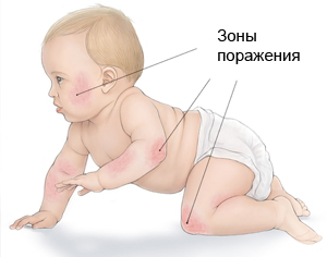Лечение атопического дерматита Харьков Ла Вита Сана