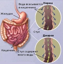 Лечение диареии (поноса) Харьков в Ла Вита Сана