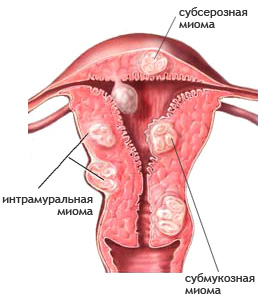 Субмукозная миома матки - методы хирургического лечения