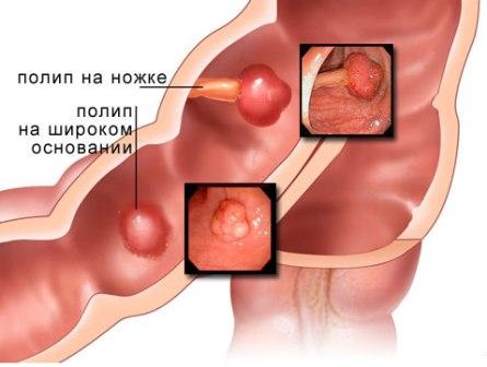 Полип в кишечнике. Лечение Харьков Ла Вита Сана