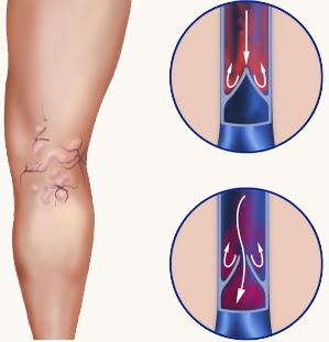 Варикозное расширение вен на ногах лечение харьков thumbnail